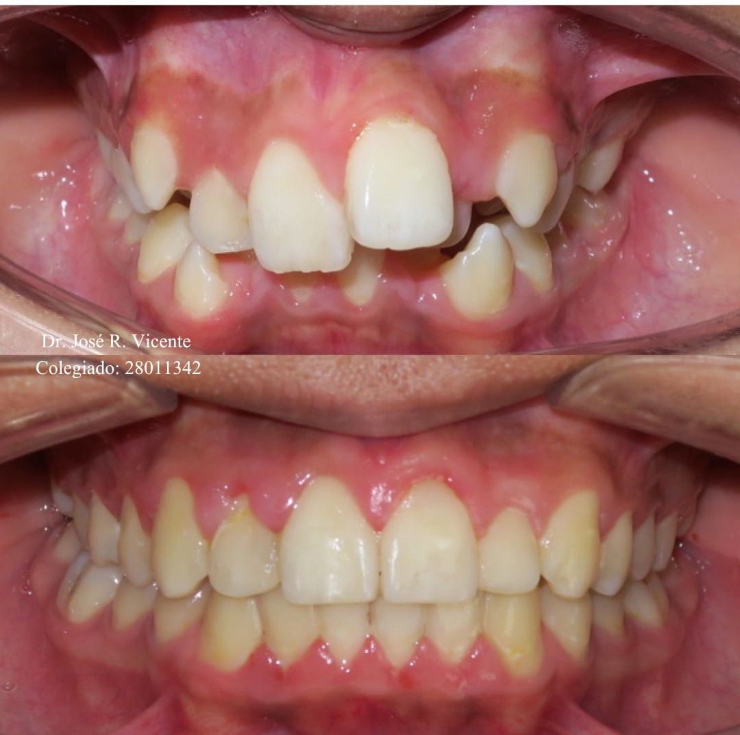 Corrección de maloclusión