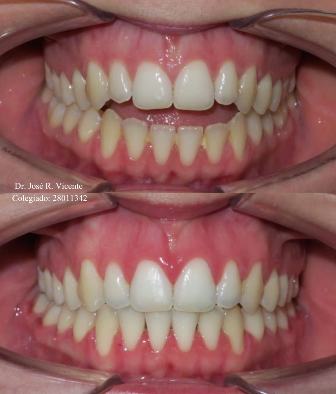 Mordida abierta avanzada