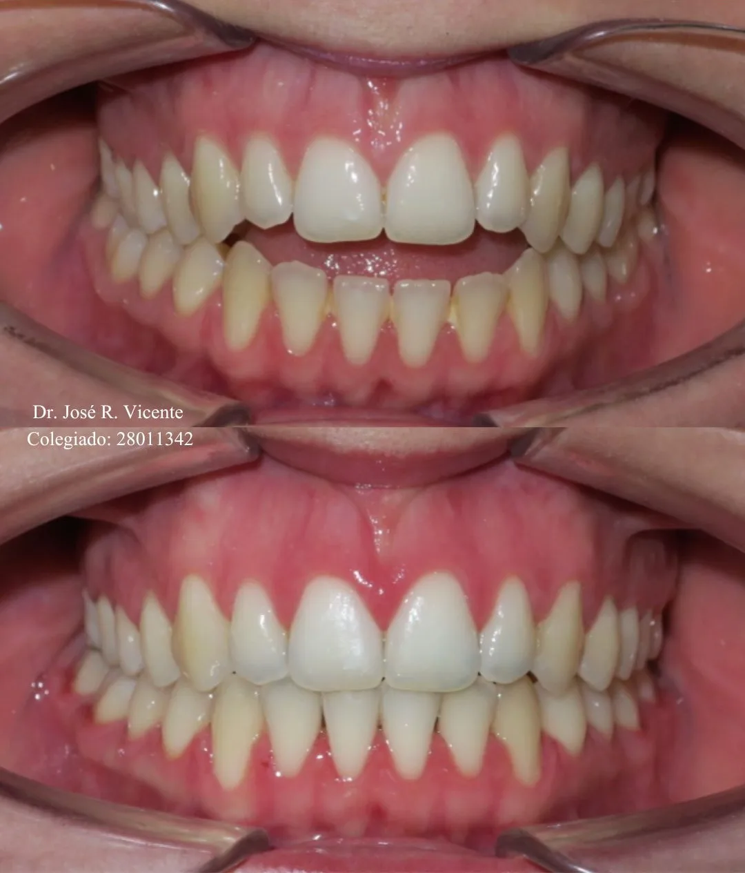 Mordida abierta avanzada