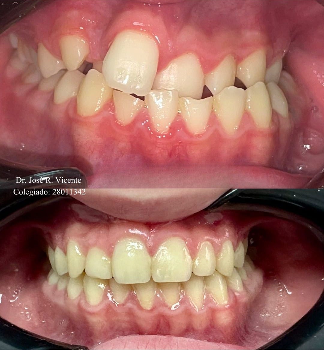 Mordida cruzada anterior