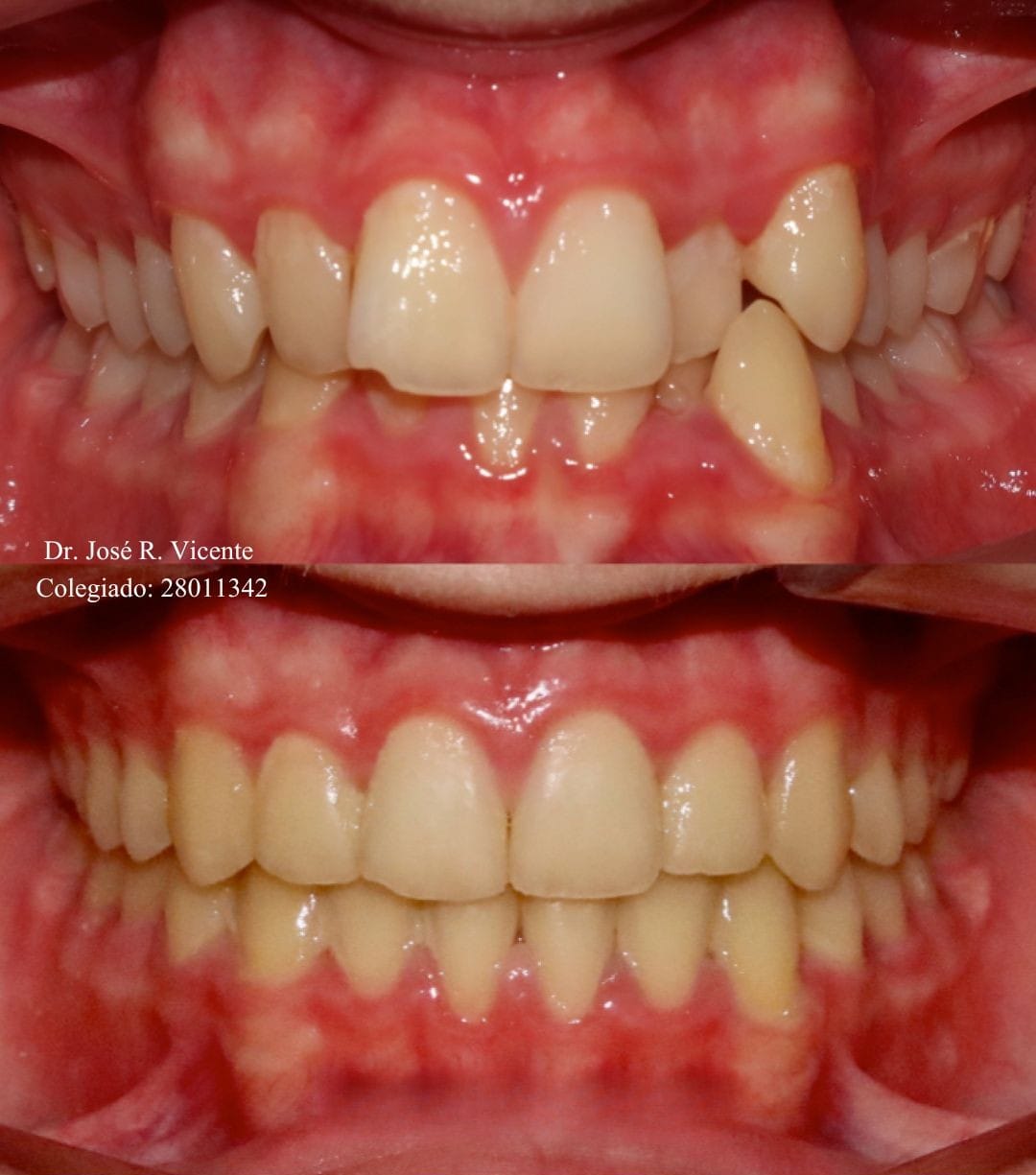 Mordida cruzada anterior