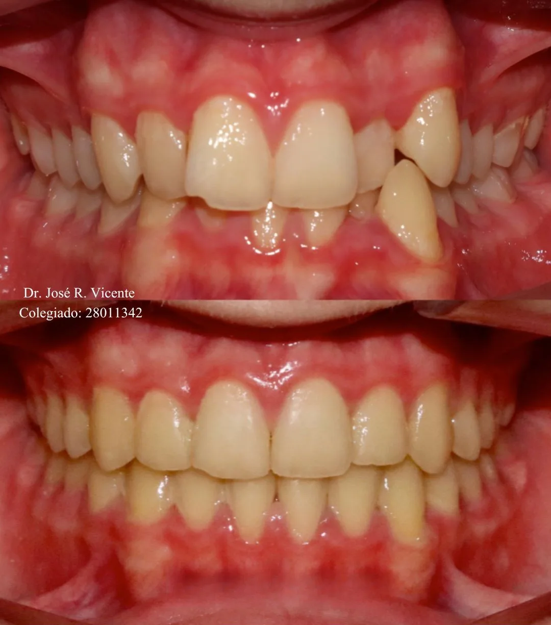 Mordida cruzada anterior